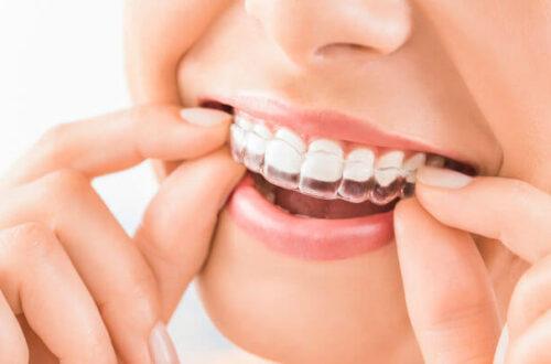 Clear Aligner Braces: A Modern Solution for Straighter Teeth 4 Invisalign 660x400 1