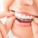 Invisalign 660x400 1