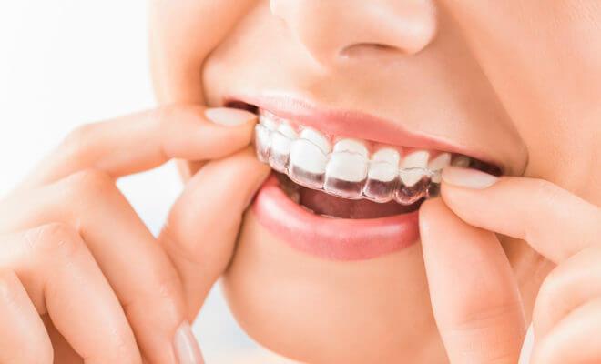 Invisalign 660x400 1